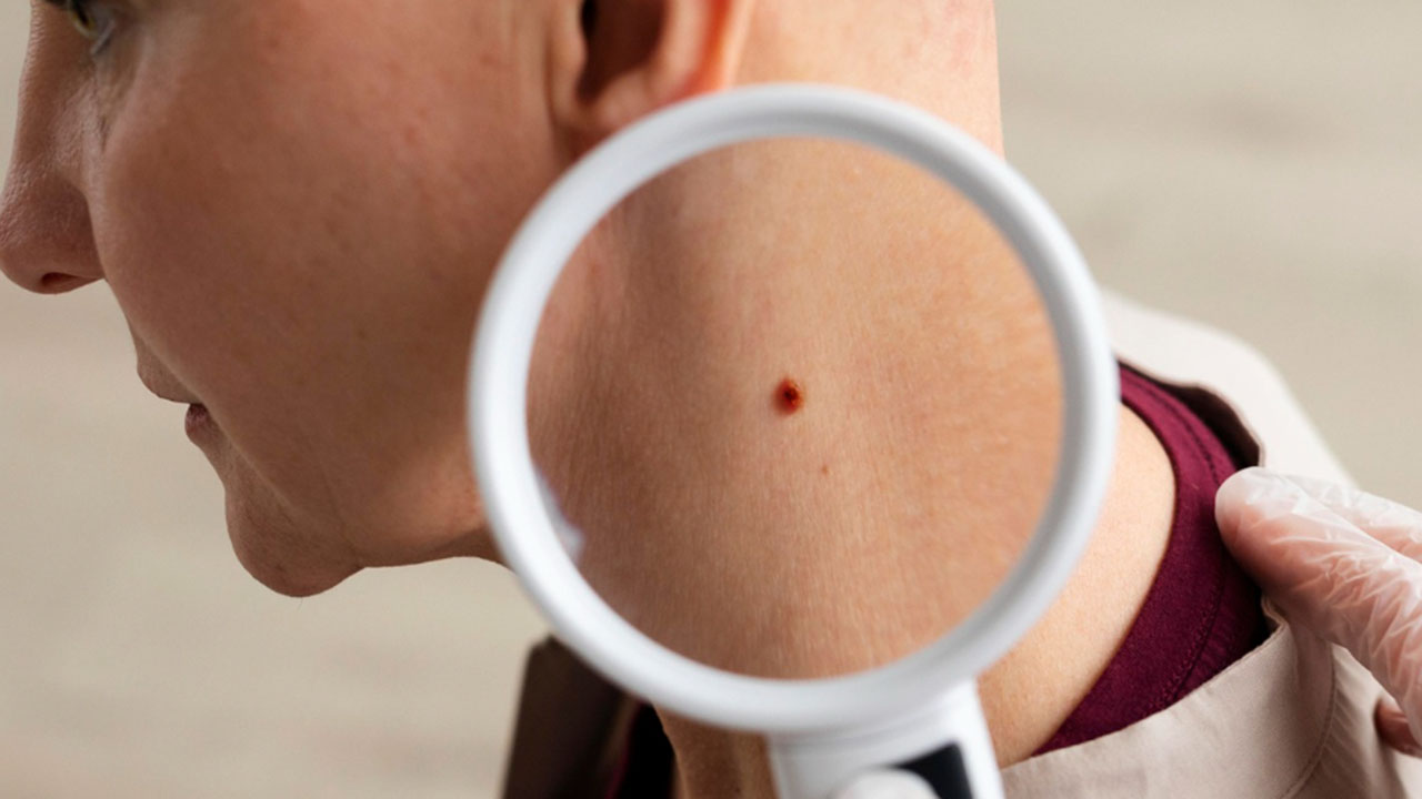 Kenali Gejala Pyoderma dan Cara Mengatasinya