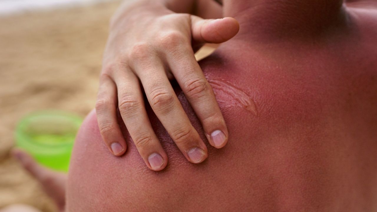 Panduan Perawatan Luka Bakar Ringan di Rumah yang Aman dan Efektif