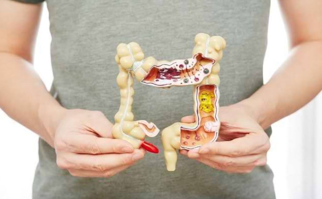 Penyakit Usus Besar: Gejala, Jenis, dan Cara Pencegahan yang Perlu Diketahui