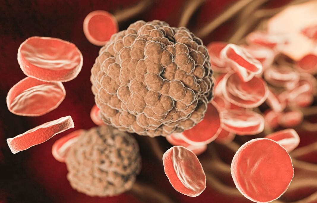 Kenapa Basofil Bisa Tinggi? Ini Penyebab dan Cara Mengatasinya