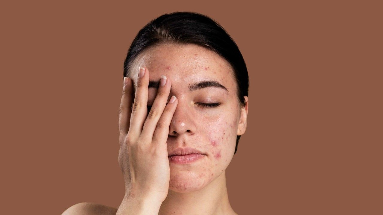 Cara Membedakan PIH dan PIE agar Bekas Jerawat Tidak Salah Ditangani