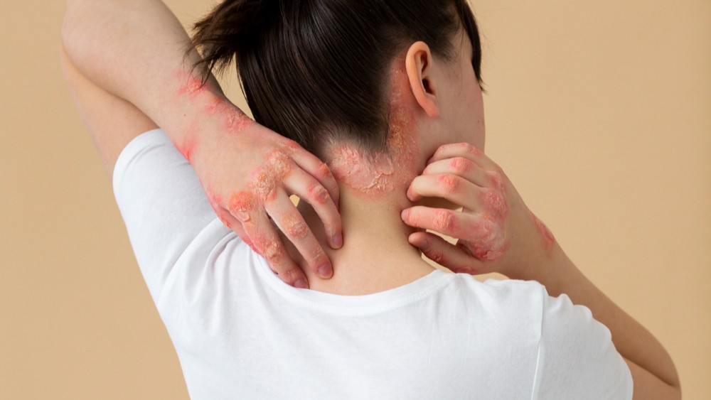 Cara Menghilangkan Kurap dengan Cepat dan Aman