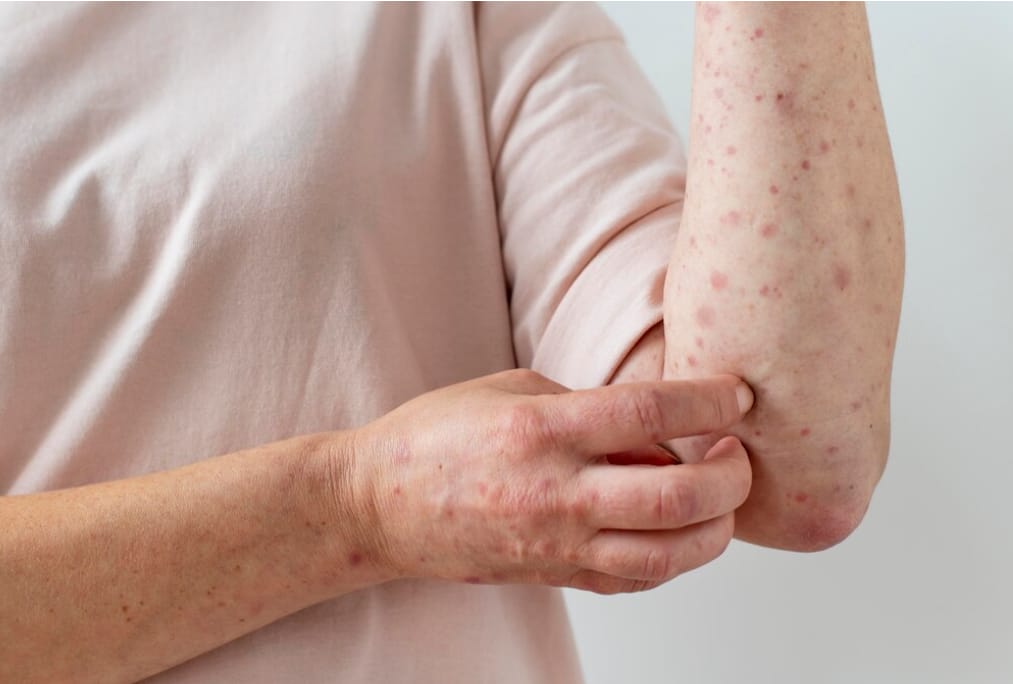 Virus Varicella Zoster, Penyebab Cacar Air dan Cacar Ular yang Perlu Diwaspadai