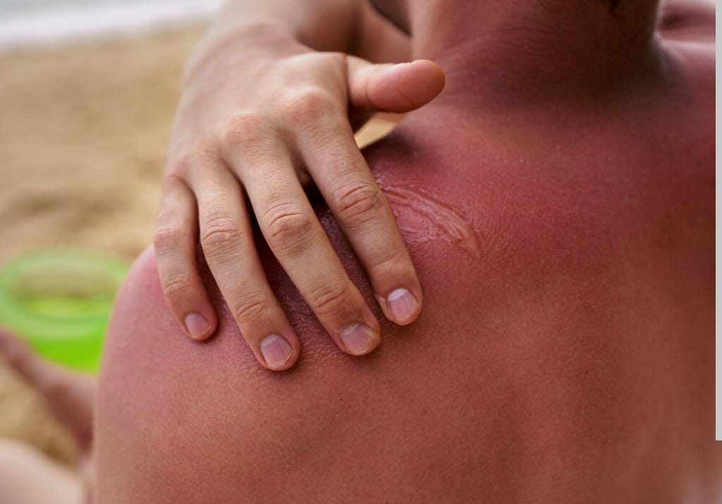 Tips Efektif Hilangkan Bekas Luka Bakar Secara Aman di Rumah