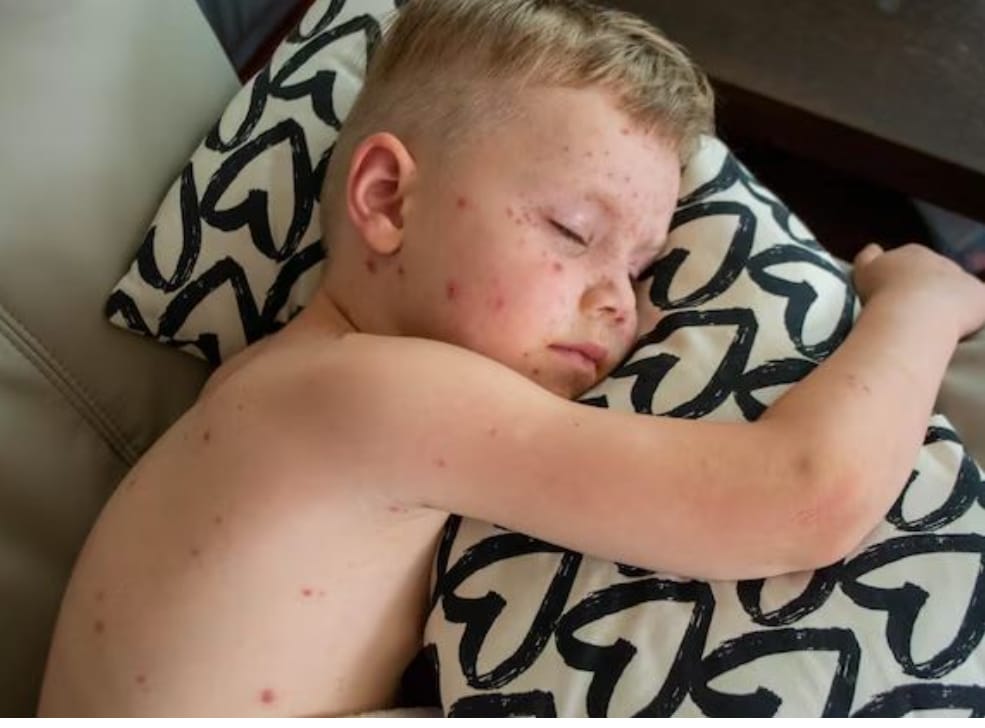 Perbedaan Campak dan Roseola yang Perlu Diketahui Orangtua