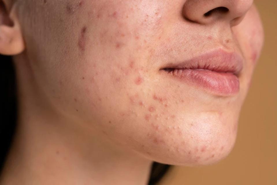 Keratosis Seboroik: Panduan Lengkap tentang Penyebab, Gejala, dan Cara Mengobatinya