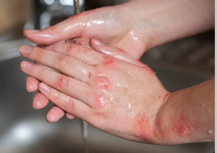 Jiggers, Ancaman Infeksi Parasit Kulit yang Sering Diabaikan tapi Berakibat Fatal