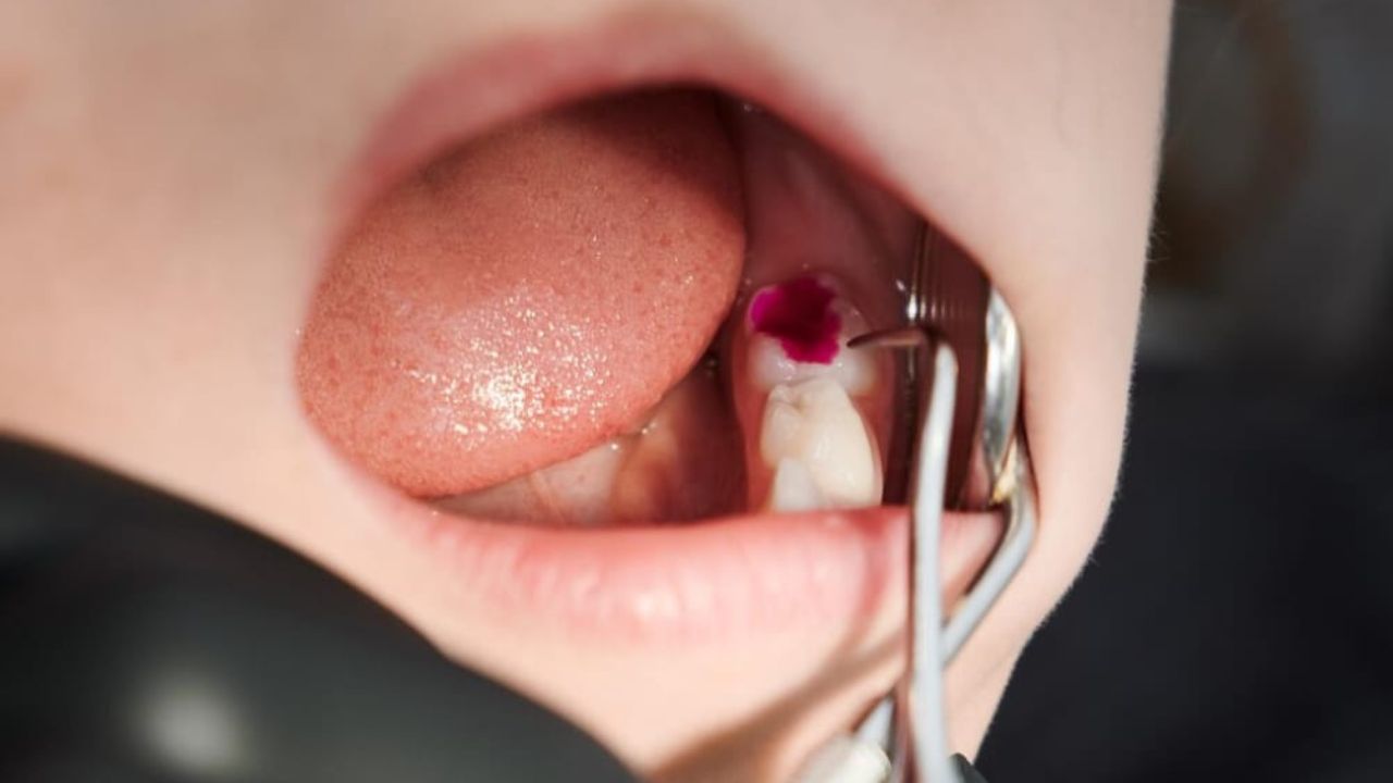 Gigi Berlubang Parah? Ini Metode Tambal yang Tepat Menurut Dokter