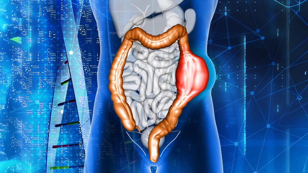 Tumor Usus Besar: Gejala, Penyebab, Diagnosis, dan Penanganan Lengkap