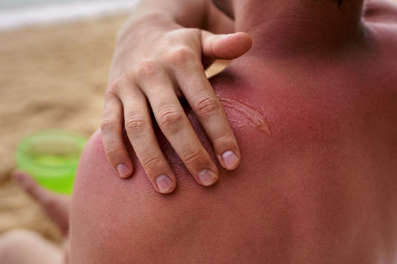 10 Cara Efektif Atasi Sunburn Tanpa Efek Samping