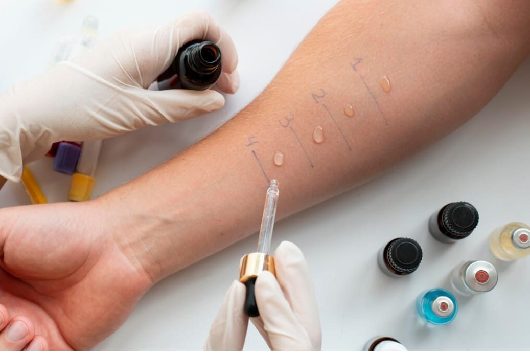 Skin Prick Test: Prosedur Cepat dan Akurat untuk Mendeteksi Alergi Sejak Dini