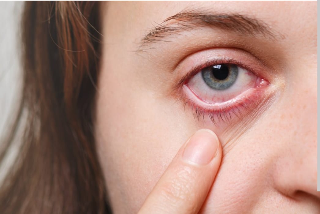 Urat Mata Merah: Tanda Iritasi Mata yang Perlu Dipahami Penyebab dan Penanganannya