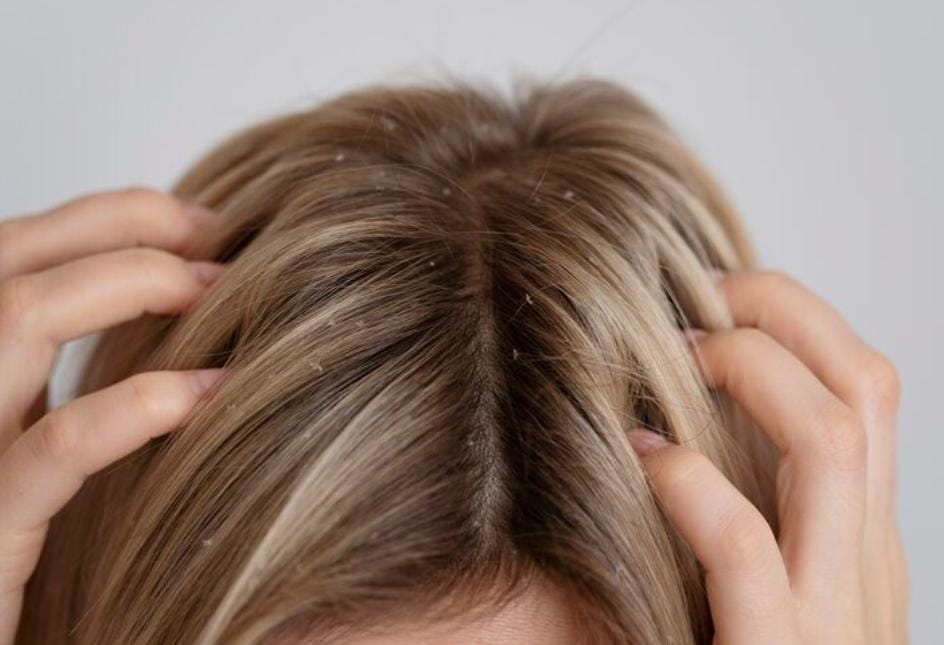 Lawan Ketombe Membandel dengan Merawat Scalp Barrier