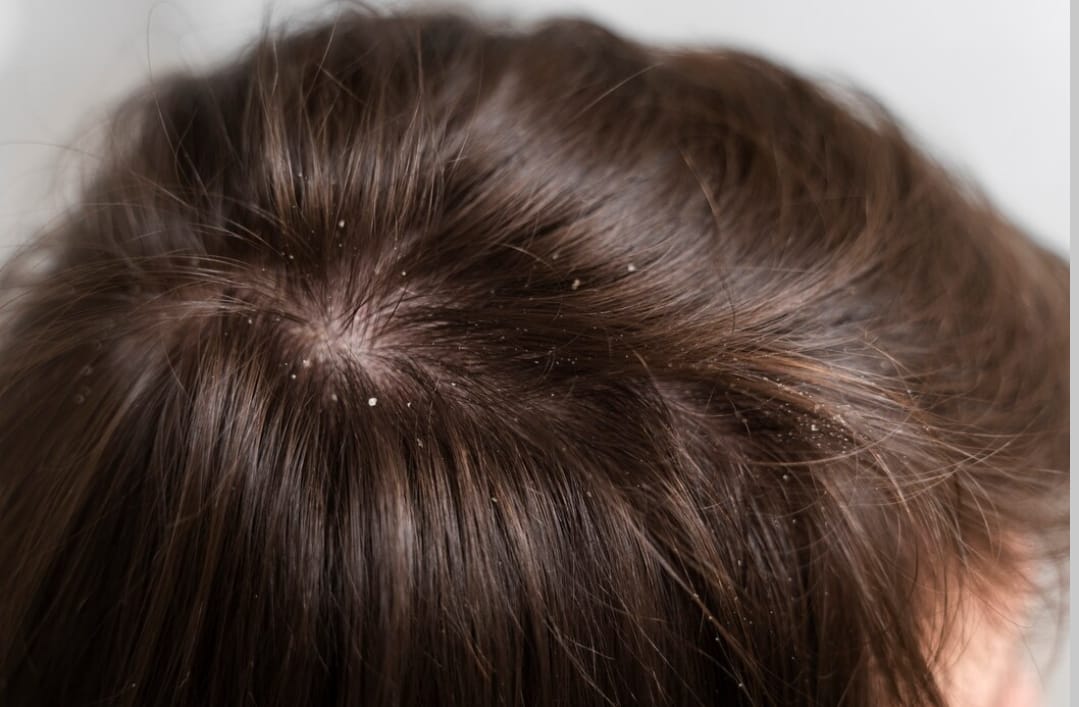 Obat Jamur Kulit di Kepala yang Ampuh: Solusi Medis dan Alami