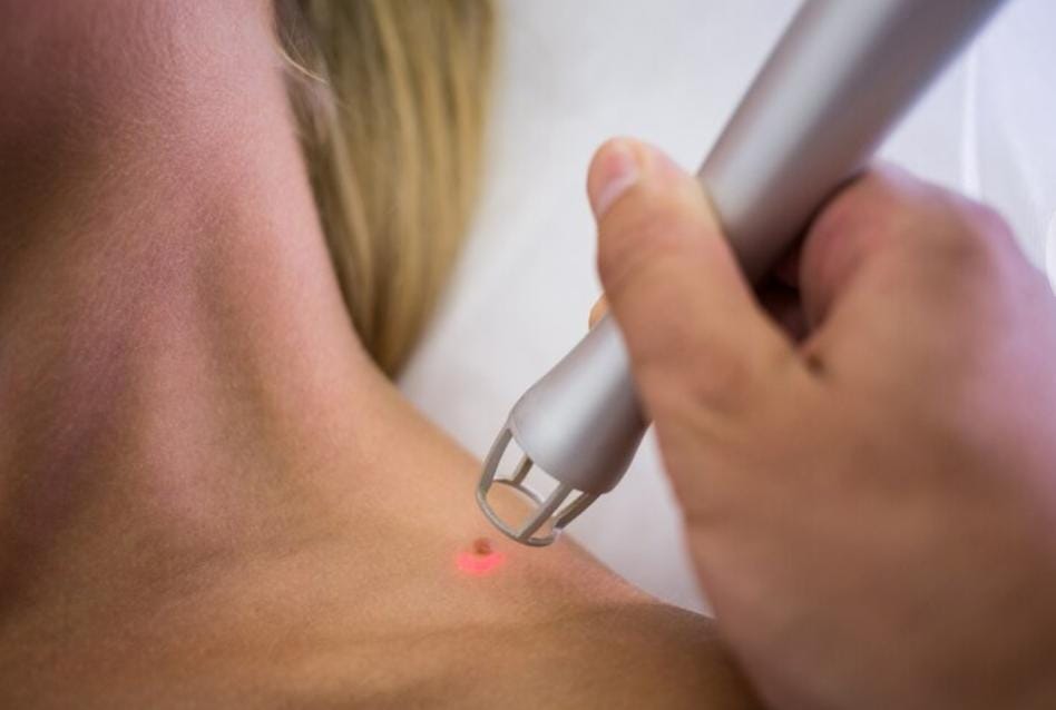 Mengenal Terapi Laser untuk Menghilangkan Keloid