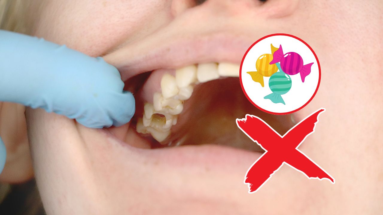 Pantangan Makanan untuk Penderita Sakit Gigi Berlubang yang Perlu Dihindari