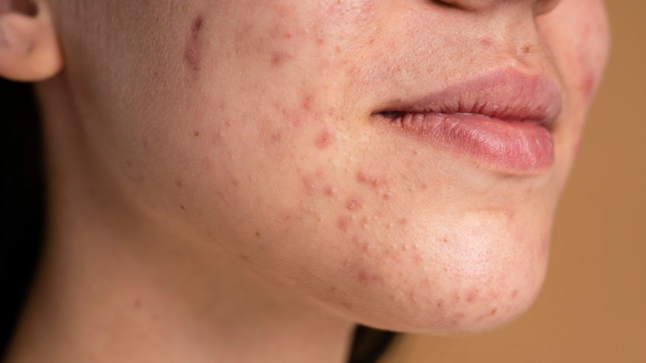 5 Cara Medis Menghilangkan Tahi Lalat di Wajah dengan Cepat dan Aman