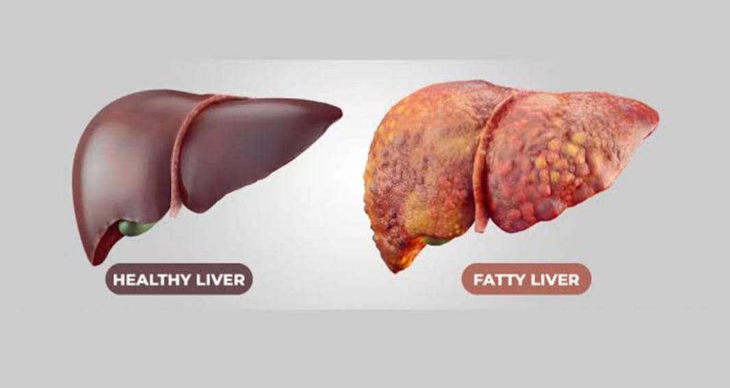 Fatty Liver Grade 2: Gejala, Penyebab, dan Cara Mengatasinya