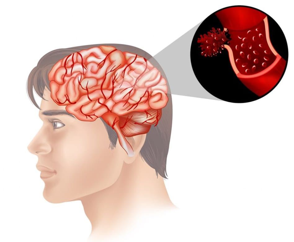 Waspada Stroke, Begini Terapi dan Tindakan Medis untuk Sumbatan Pembuluh Darah Otak