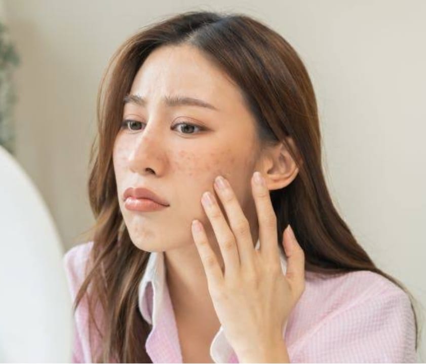 Obat Penghilang Flek Hitam Paling Ampuh dan Aman di Wajah