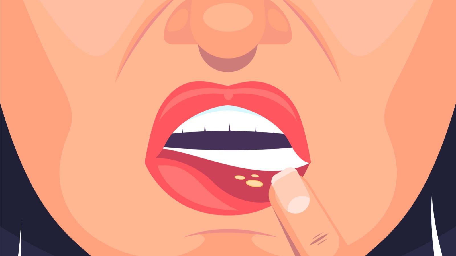 Berapa Lama Sariawan Sembuh? Ini Penjelasan dan Cara Mengatasinya