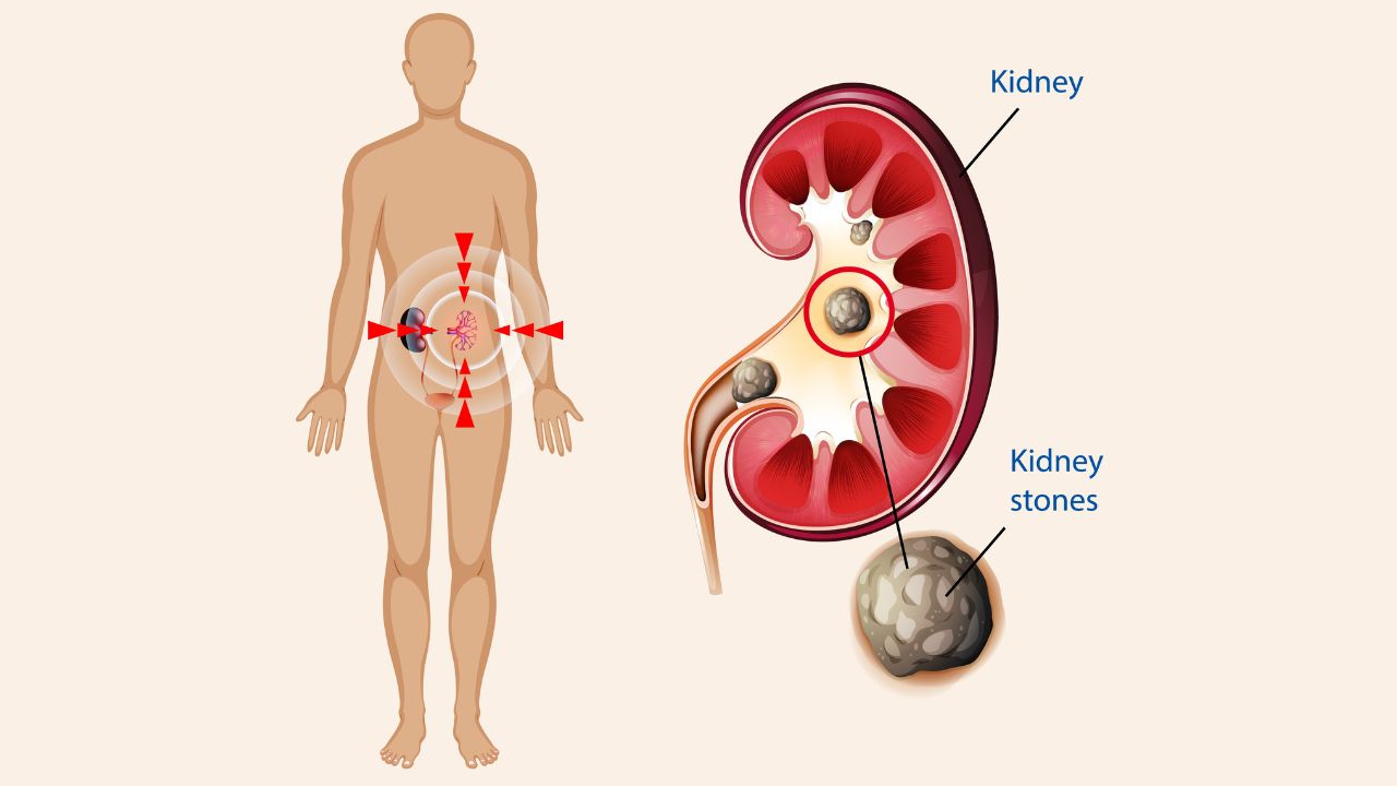 Operasi Laser Batu Ginjal: Prosedur Modern Mengatasi Nyeri Tanpa Sayatan