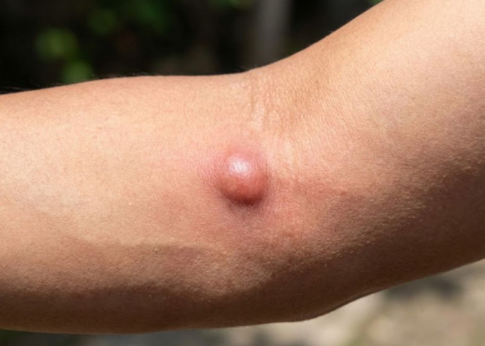 Waspada, Inilah Ciri-Ciri Lipoma Ganas yang Sering Dianggap Sepele