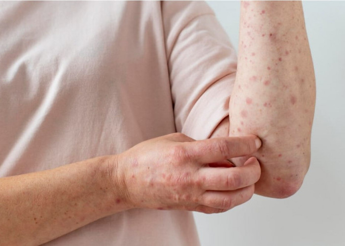 Virus Varicella Zoster, Penyebab Cacar Air dan Cacar Ular yang Perlu Diwaspadai