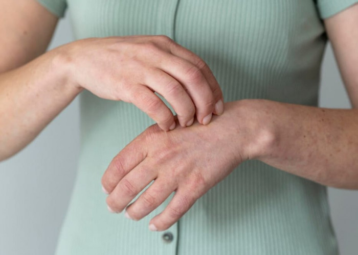 Jari Tangan Gatal dan Bintik Berair? Ini Penyebab dan Cara Mengatasinya