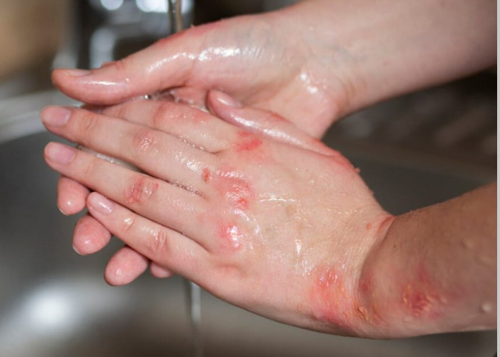 Jiggers, Ancaman Infeksi Parasit Kulit yang Sering Diabaikan tapi Berakibat Fatal