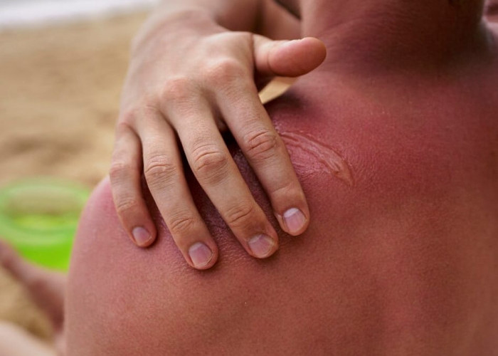 Kenali Tanda Luka Bernanah Mulai Sembuh, Hindari Salah Penanganan yang Berisiko