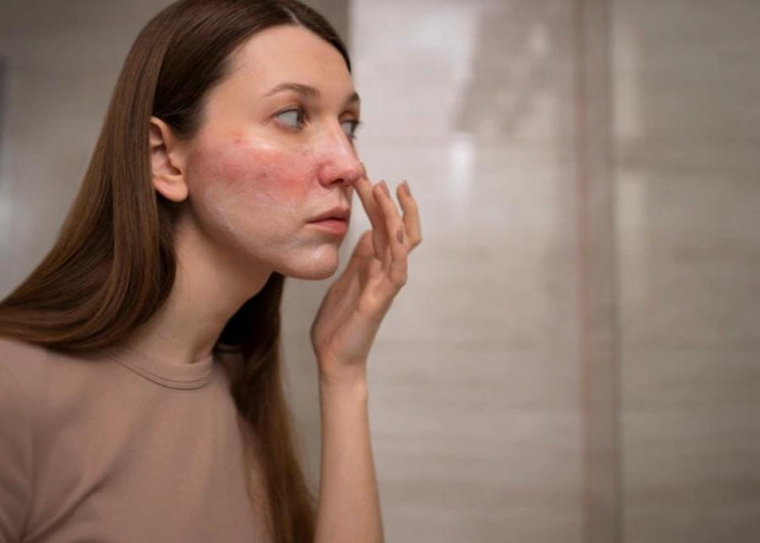 Spider Veins di Wajah: Kenali Penyebab dan Cara Mengatasinya