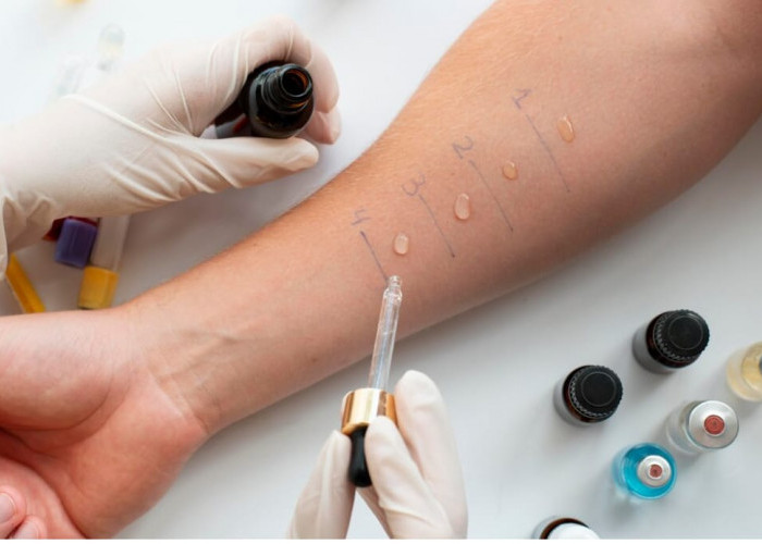 Skin Prick Test: Prosedur Cepat dan Akurat untuk Mendeteksi Alergi Sejak Dini