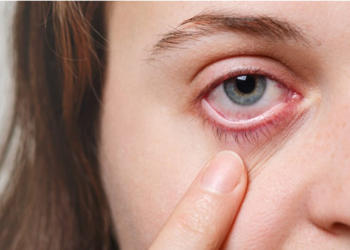 Urat Mata Merah: Tanda Iritasi Mata yang Perlu Dipahami Penyebab dan Penanganannya