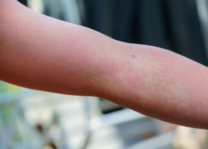 Inilah Penyebab Alergi pada Kulit dan Cara Mengatasinya