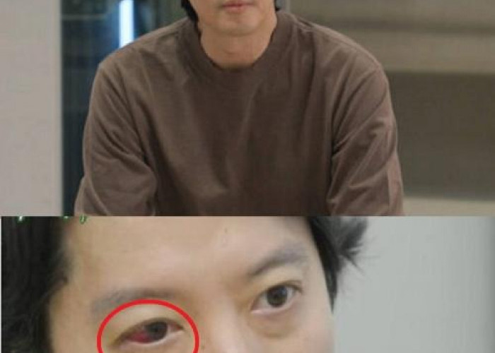 Lee Dong Gun Idap Penyakit Langka Ankylosing Spondylitis