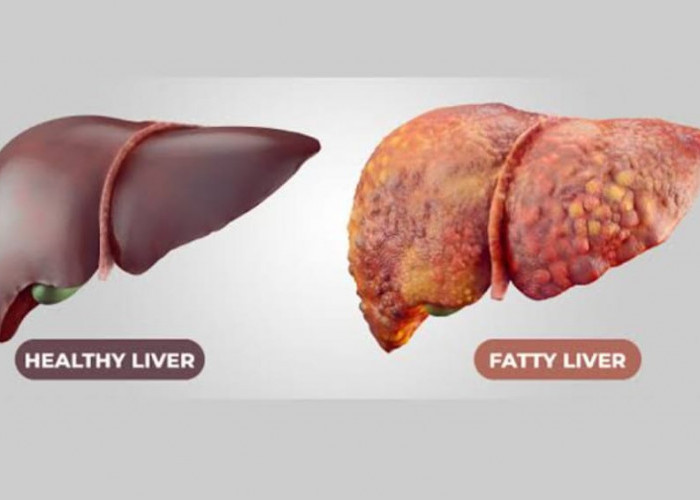Fatty Liver Grade 2: Gejala, Penyebab, dan Cara Mengatasinya