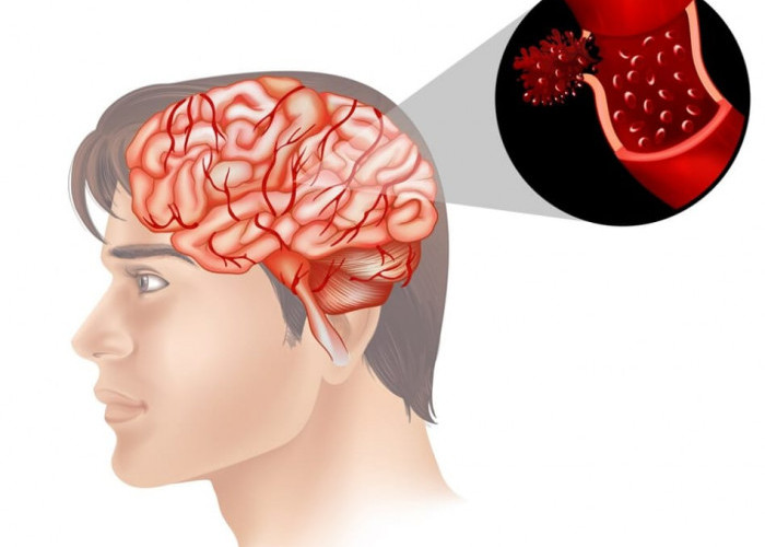 Waspada Stroke, Begini Terapi dan Tindakan Medis untuk Sumbatan Pembuluh Darah Otak