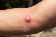 Waspada, Inilah Ciri-Ciri Lipoma Ganas yang Sering Dianggap Sepele