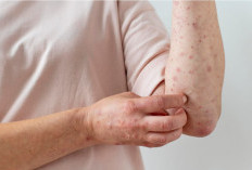 Virus Varicella Zoster, Penyebab Cacar Air dan Cacar Ular yang Perlu Diwaspadai