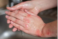 Jiggers, Ancaman Infeksi Parasit Kulit yang Sering Diabaikan tapi Berakibat Fatal