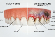 Waspada! Perubahan Warna Gusi Bisa Jadi Tanda Masalah Serius pada Kesehatan Mulut