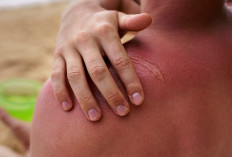 Kenali Tanda Luka Bernanah Mulai Sembuh, Hindari Salah Penanganan yang Berisiko