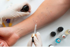 Skin Prick Test: Prosedur Cepat dan Akurat untuk Mendeteksi Alergi Sejak Dini
