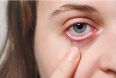 Urat Mata Merah: Tanda Iritasi Mata yang Perlu Dipahami Penyebab dan Penanganannya