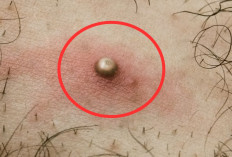 Bisul Mulai Muncul? Ini Langkah Pencegahan Efektif agar Tidak Membesar