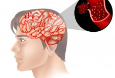 Waspada Stroke, Begini Terapi dan Tindakan Medis untuk Sumbatan Pembuluh Darah Otak