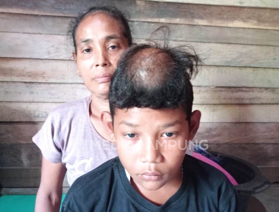 Derita Penyakit Benjolan di Kepala, Rezki Saputra Butuh Uluran Tangan