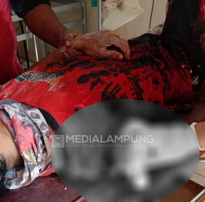 Karyawan Pabrik Tapioka Alami Kecelakaan Kerja Hingga Lengan Terputus