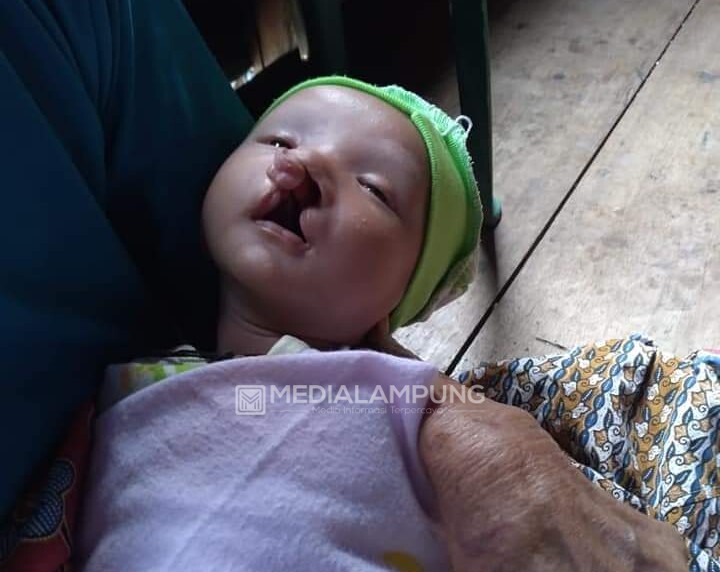 Faris, Bayi Mungil Penderita Bibir Sumbing ini Butuh Bantuan 